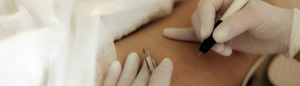 Epilation Electrique Définitive pour les poils blancs et roux