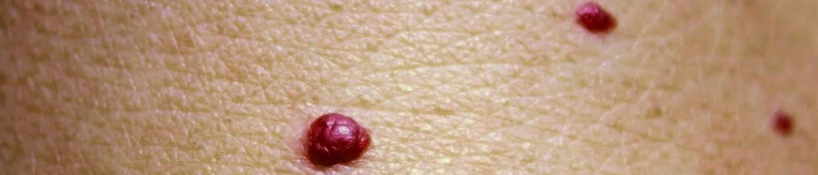 Traitement angiomes et varicosités chez le dr Charlot