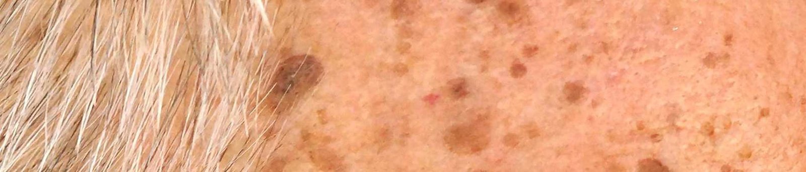 Kératose Séborrhéique à Niort