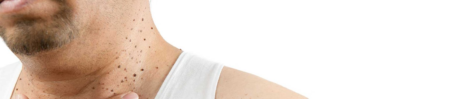 Kératose Séborrhéique à Niort