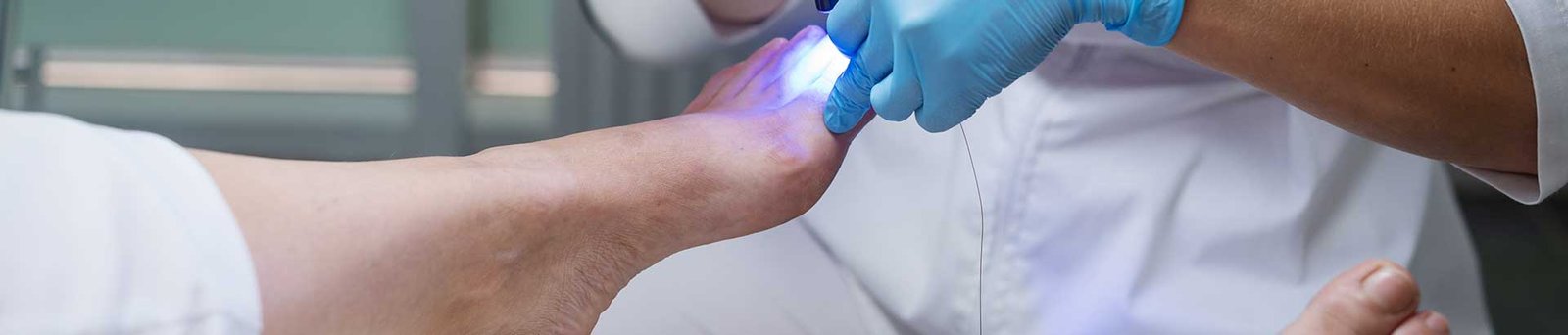 Traitement de l'Onychomycose à Niort