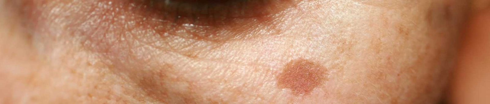 Traiter les tâches pigmentaires brunes, le teint