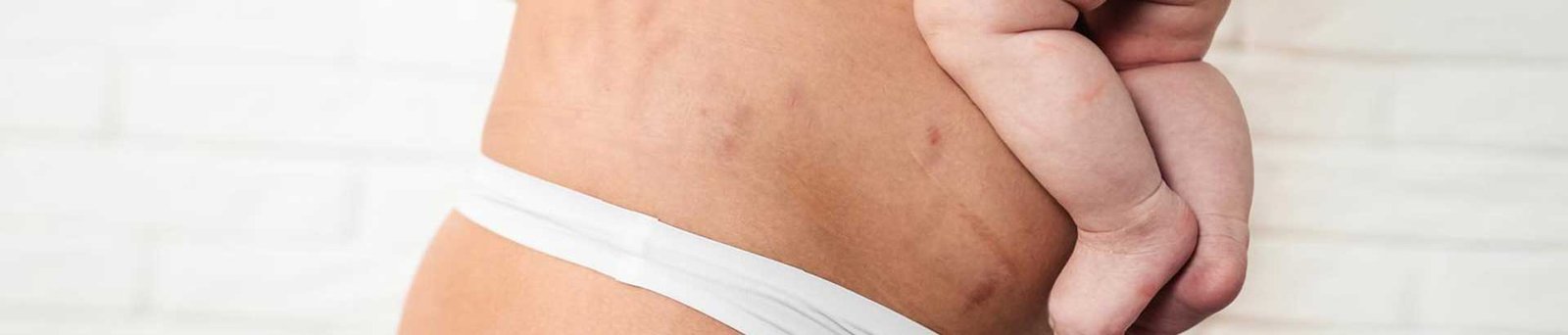 Traitement de vergetures à Niort par le dr Charlot