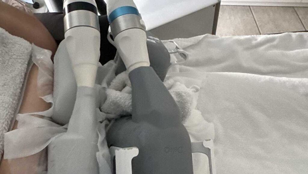 Cryolipolyse pour le ventre et la ménopause à Niort