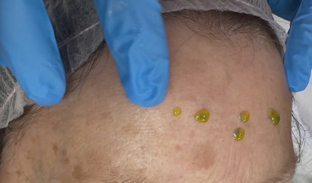 BioRePeel® : le peeling nouvelle génération